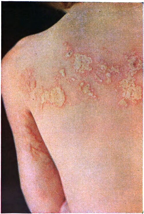 Faixa característica do Herpes Zóster nas costas