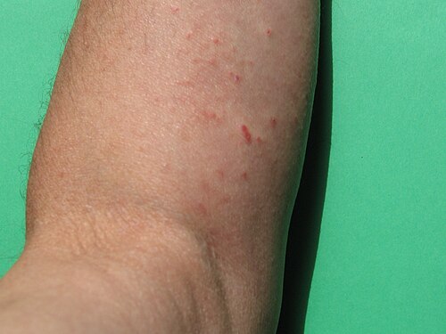 Herpes Zóster no braço