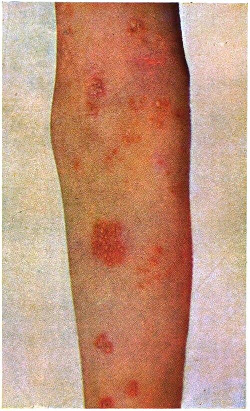 Lesões de Herpes Zóster na perna