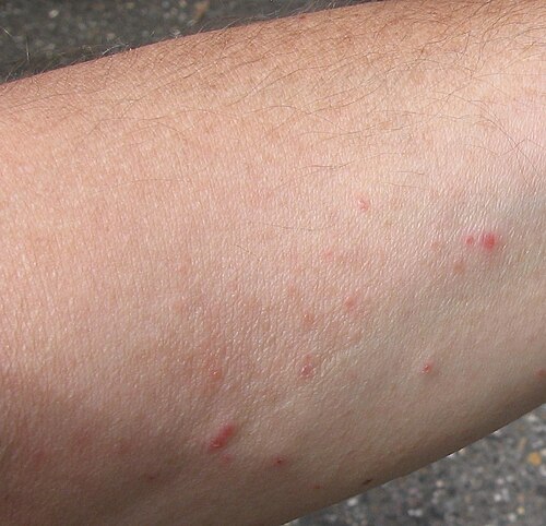 Herpes Zóster no braço, fase inicial